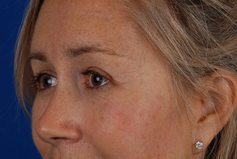 Brow Lift Before & After Gallery - Patient 12974004 - Image 4