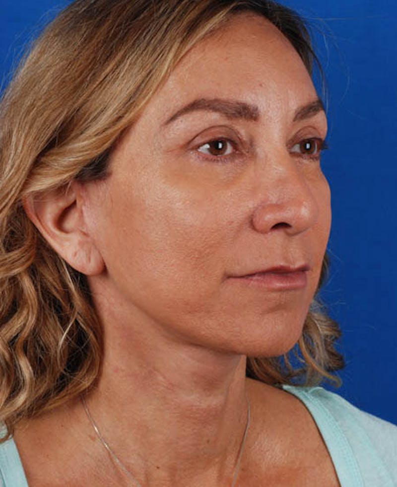 Facelift Before & After Gallery - Patient 12974003 - Image 10