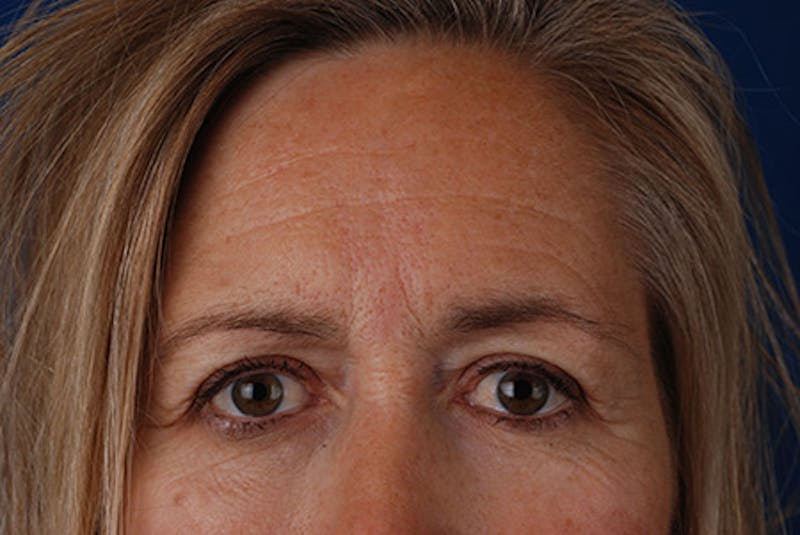Brow Lift Before & After Gallery - Patient 12974004 - Image 5