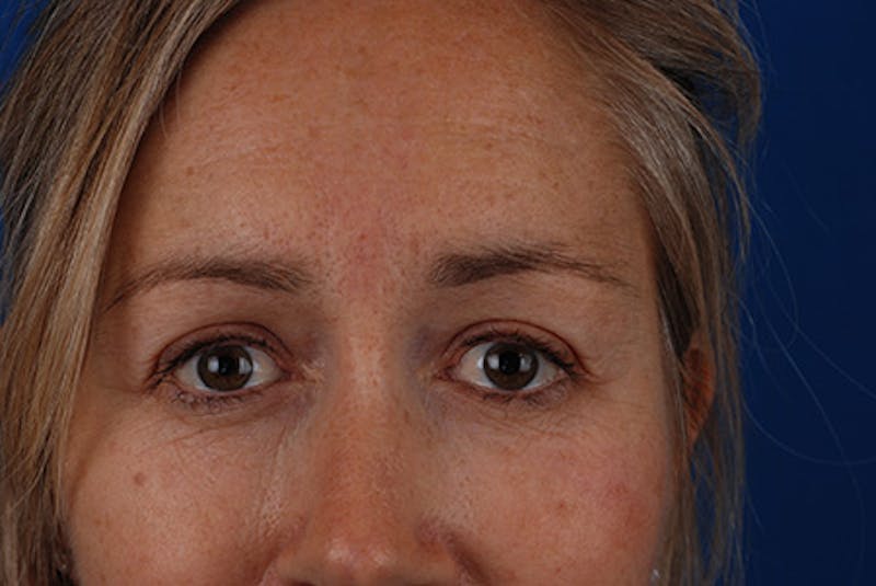 Brow Lift Before & After Gallery - Patient 12974004 - Image 6