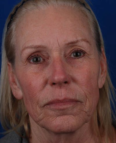 Facelift Before & After Gallery - Patient 12974007 - Image 1