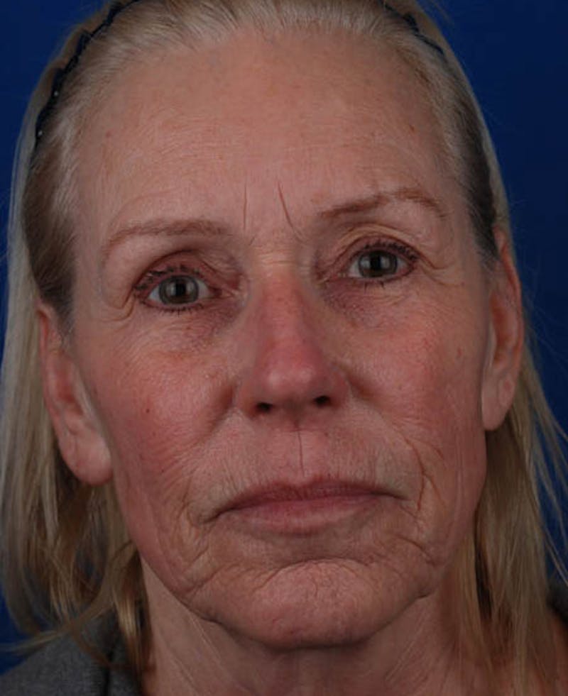 Facelift Before & After Gallery - Patient 12974007 - Image 1