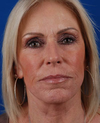 Facelift Before & After Gallery - Patient 12974007 - Image 2