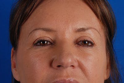 Brow Lift Before & After Gallery - Patient 12974005 - Image 1