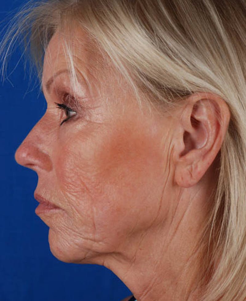 Facelift Before & After Gallery - Patient 12974007 - Image 3