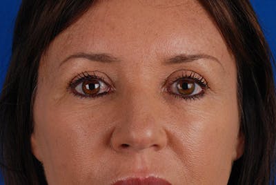 Brow Lift Before & After Gallery - Patient 12974005 - Image 2