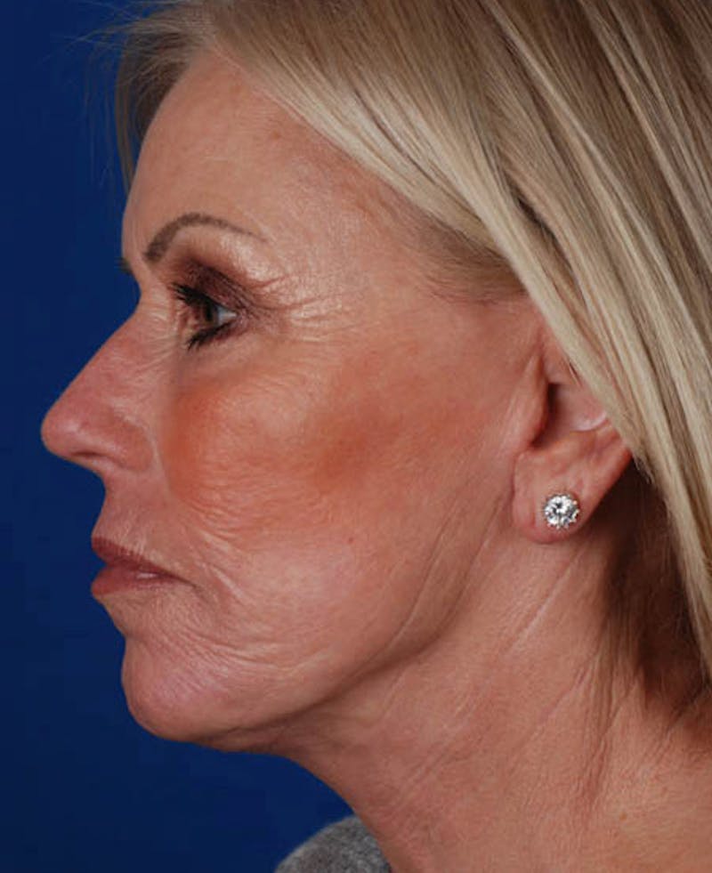 Facelift Before & After Gallery - Patient 12974007 - Image 4