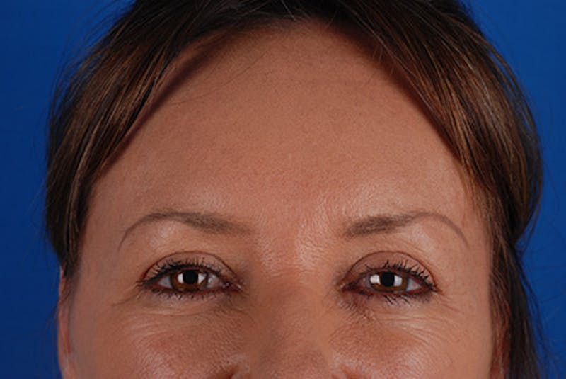 Brow Lift Before & After Gallery - Patient 12974005 - Image 3