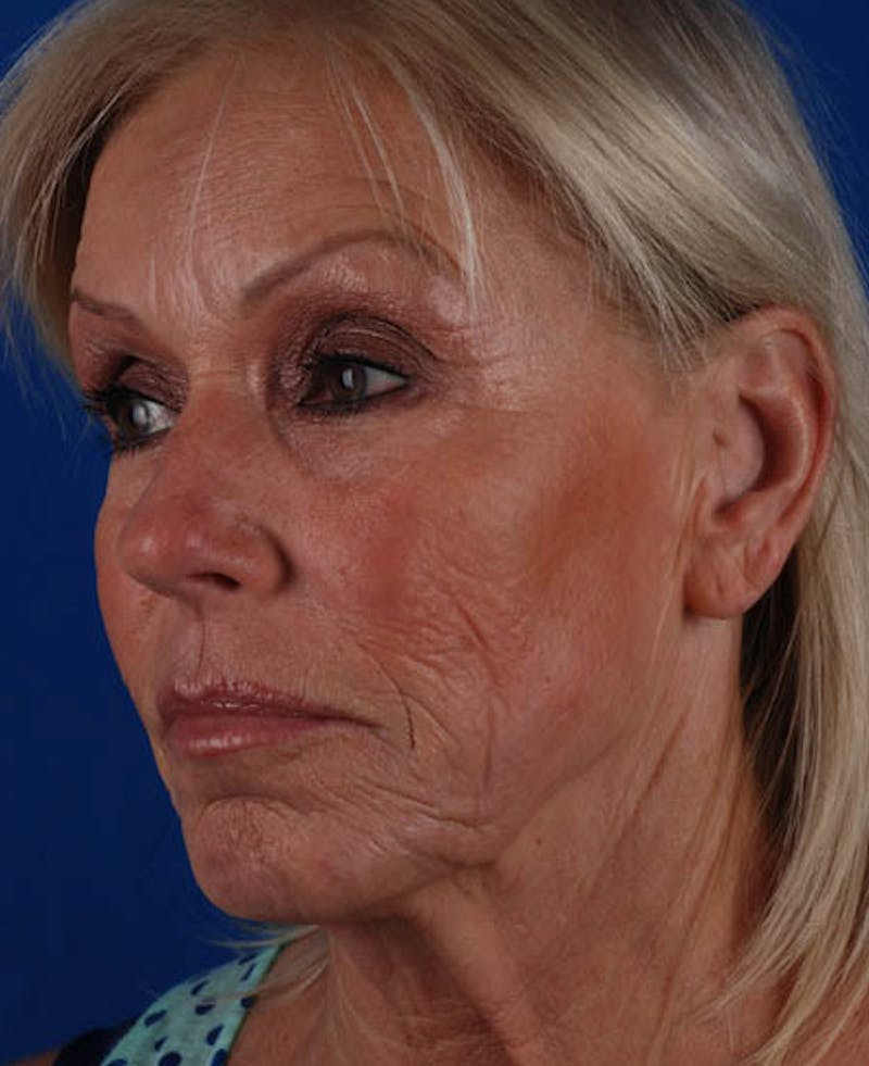 Facelift Before & After Gallery - Patient 12974007 - Image 5