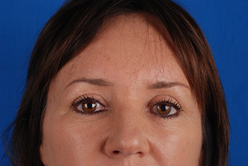 Brow Lift Before & After Gallery - Patient 12974005 - Image 4