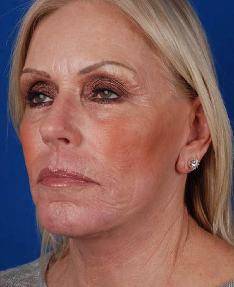 Facelift Before & After Gallery - Patient 12974007 - Image 6