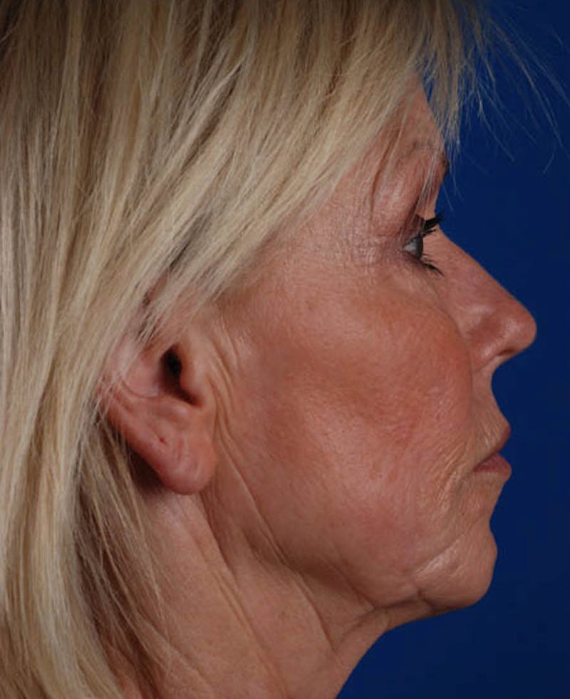 Facelift Before & After Gallery - Patient 12974007 - Image 7
