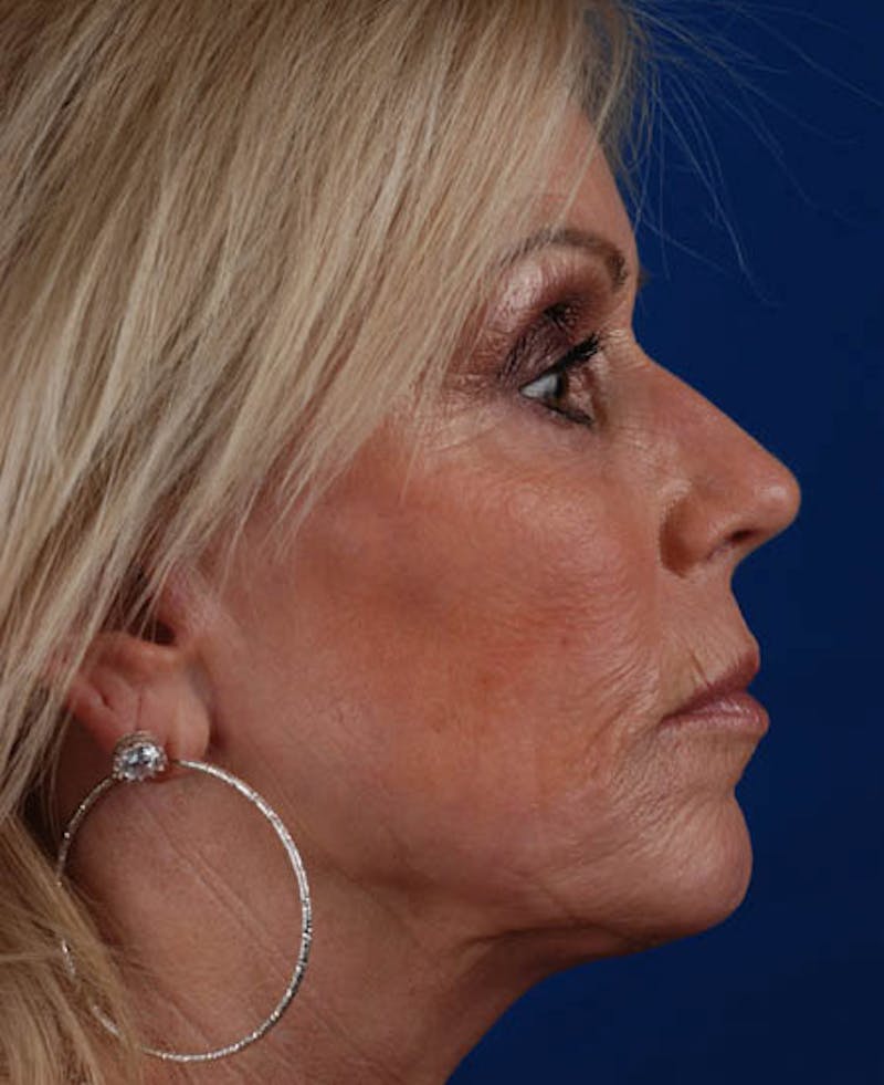 Facelift Before & After Gallery - Patient 12974007 - Image 8