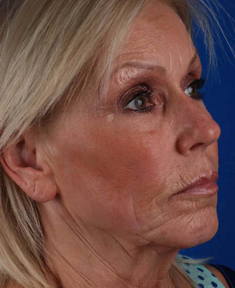 Facelift Before & After Gallery - Patient 12974007 - Image 9