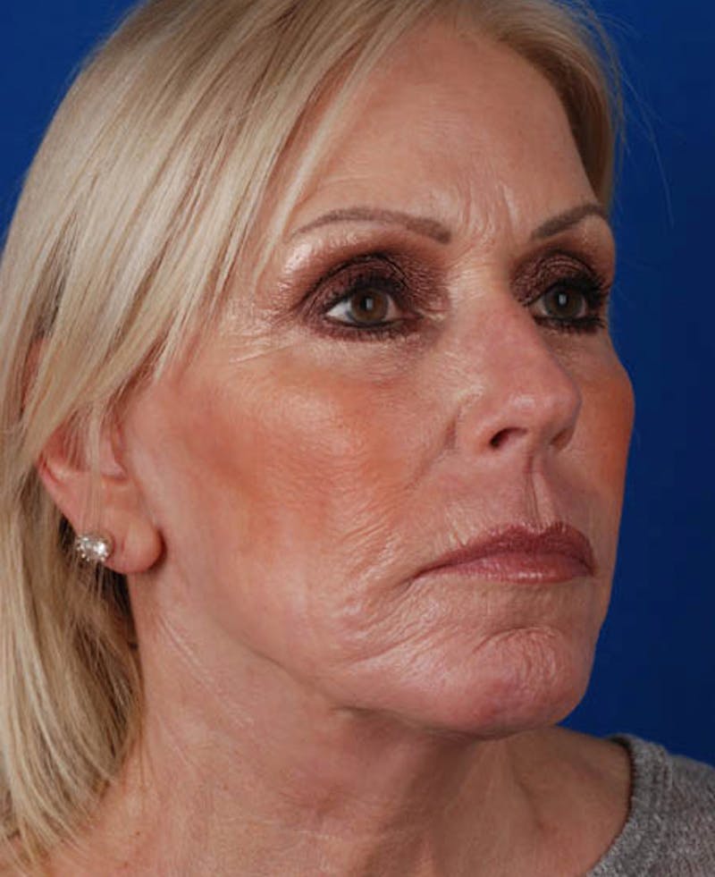 Facelift Before & After Gallery - Patient 12974007 - Image 10