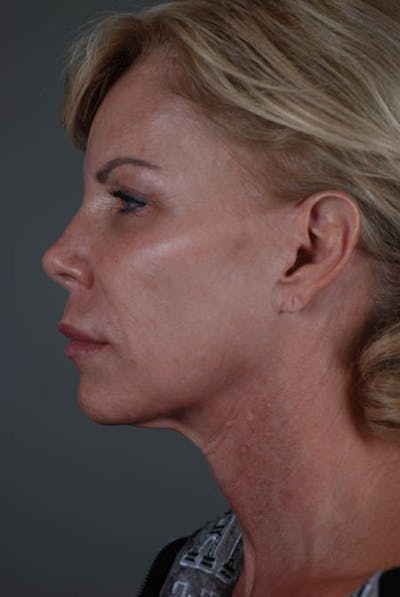 Neck Lift Before & After Gallery - Patient 12974010 - Image 1
