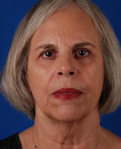Facelift Before & After Gallery - Patient 12974011 - Image 1