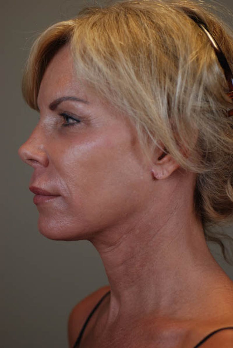 Neck Lift Before & After Gallery - Patient 12974010 - Image 2