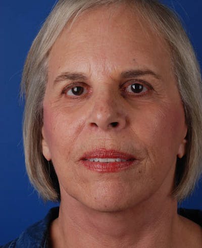 Facelift Before & After Gallery - Patient 12974011 - Image 2