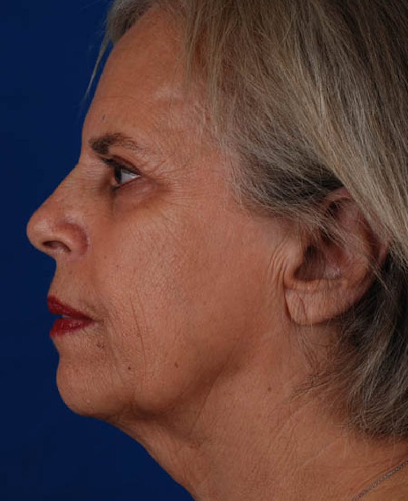 Facelift Before & After Gallery - Patient 12974011 - Image 3