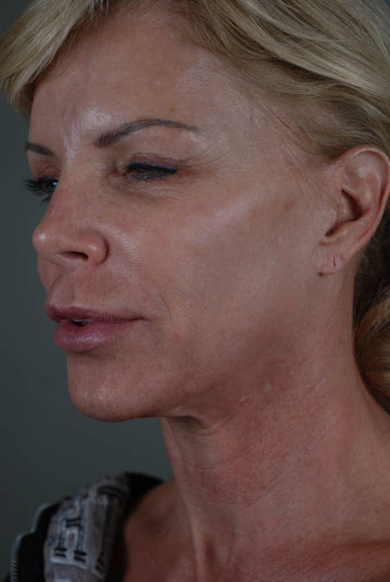 Neck Lift Before & After Gallery - Patient 12974010 - Image 3