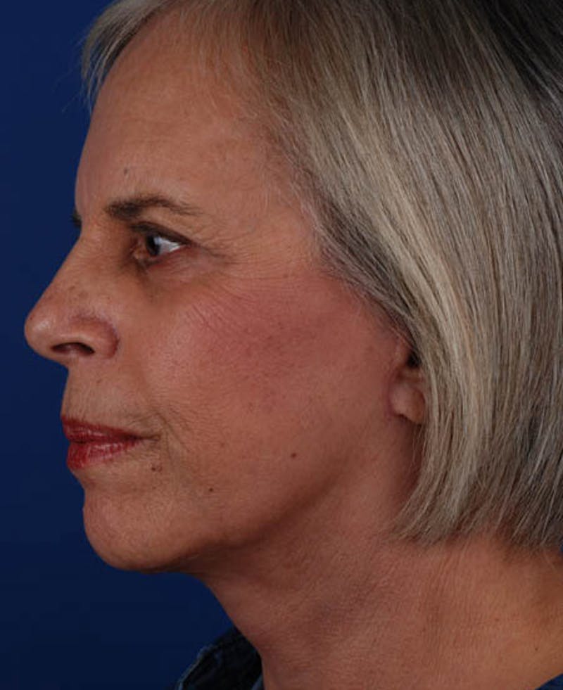Facelift Before & After Gallery - Patient 12974011 - Image 4