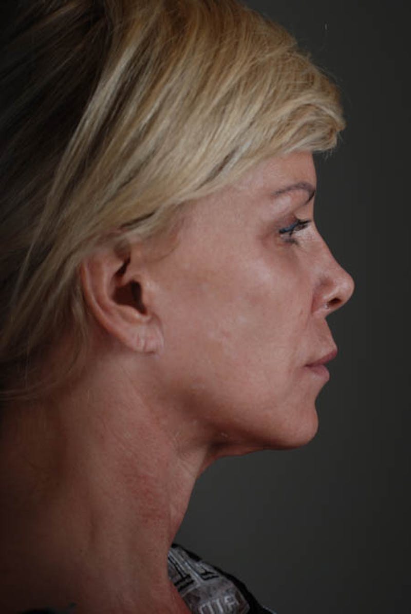 Neck Lift Before & After Gallery - Patient 12974010 - Image 5