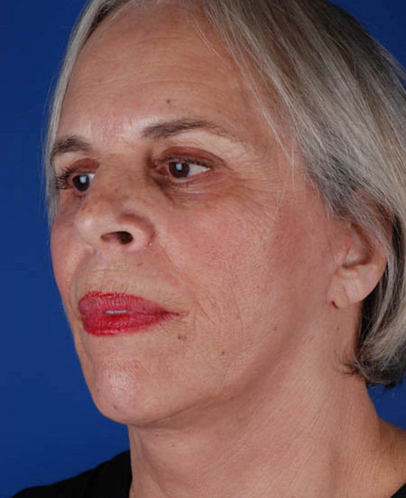 Facelift Before & After Gallery - Patient 12974011 - Image 6