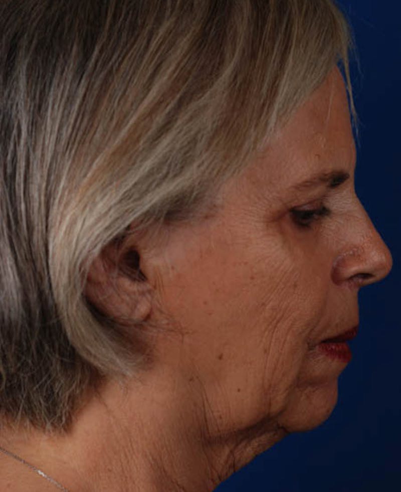 Facelift Before & After Gallery - Patient 12974011 - Image 7