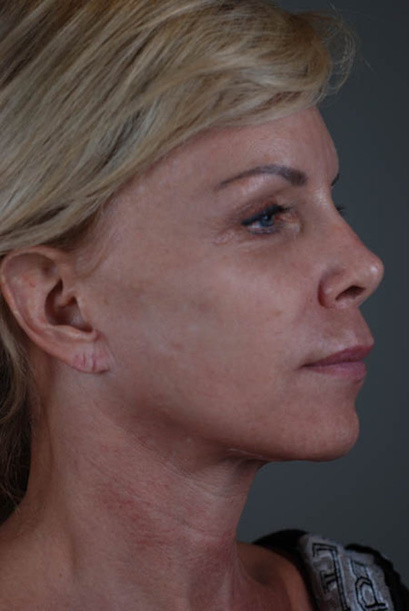 Neck Lift Before & After Gallery - Patient 12974010 - Image 7