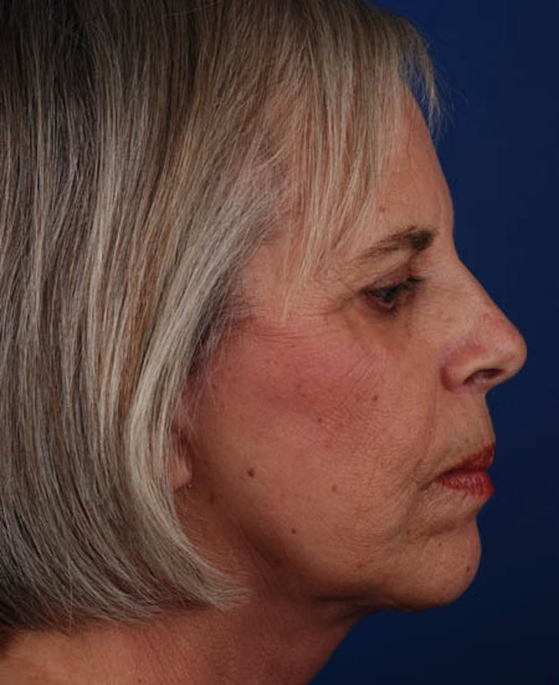 Facelift Before & After Gallery - Patient 12974011 - Image 8