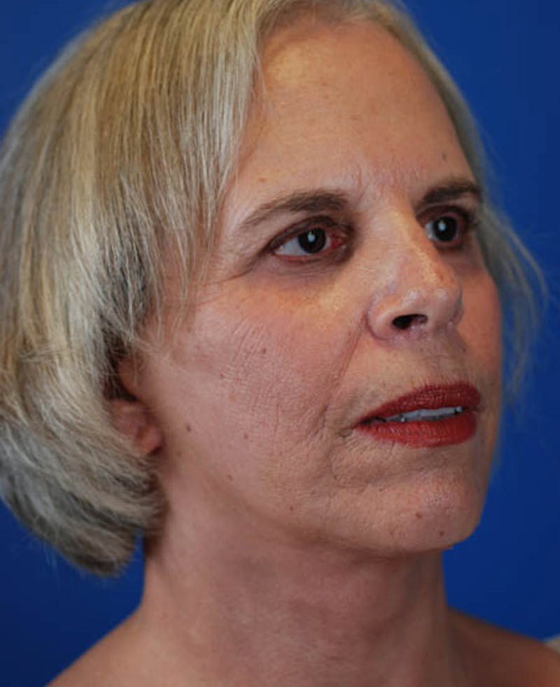 Facelift Before & After Gallery - Patient 12974011 - Image 10