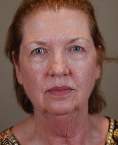 Facelift Before & After Gallery - Patient 12974012 - Image 1