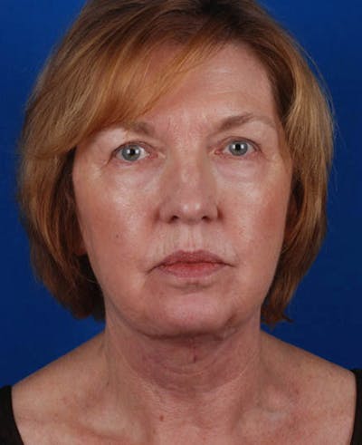 Facelift Before & After Gallery - Patient 12974012 - Image 2