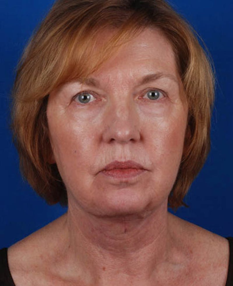 Facelift Before & After Gallery - Patient 12974012 - Image 2