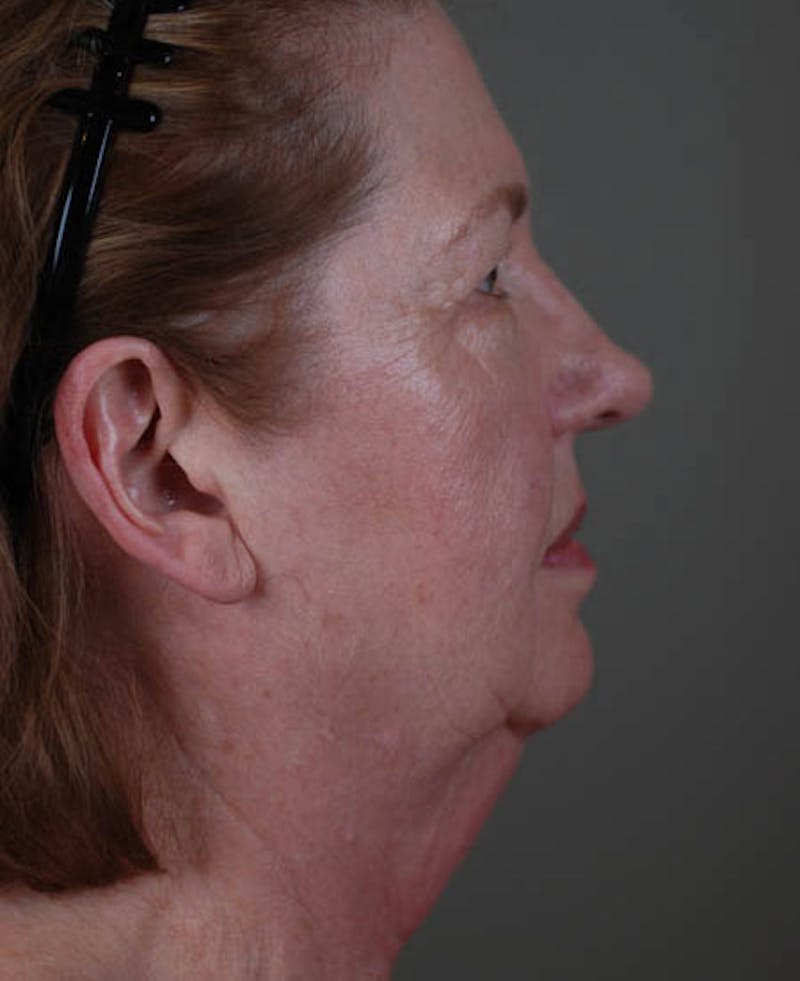 Facelift Before & After Gallery - Patient 12974012 - Image 3