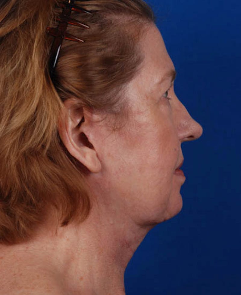Facelift Before & After Gallery - Patient 12974012 - Image 4