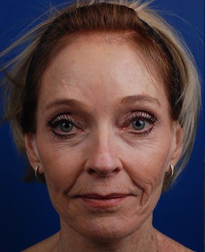 Facelift Before & After Gallery - Patient 12974014 - Image 1