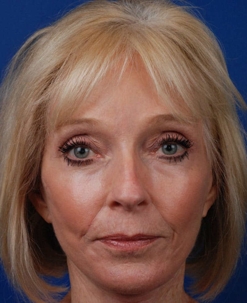 Facelift Before & After Gallery - Patient 12974014 - Image 2
