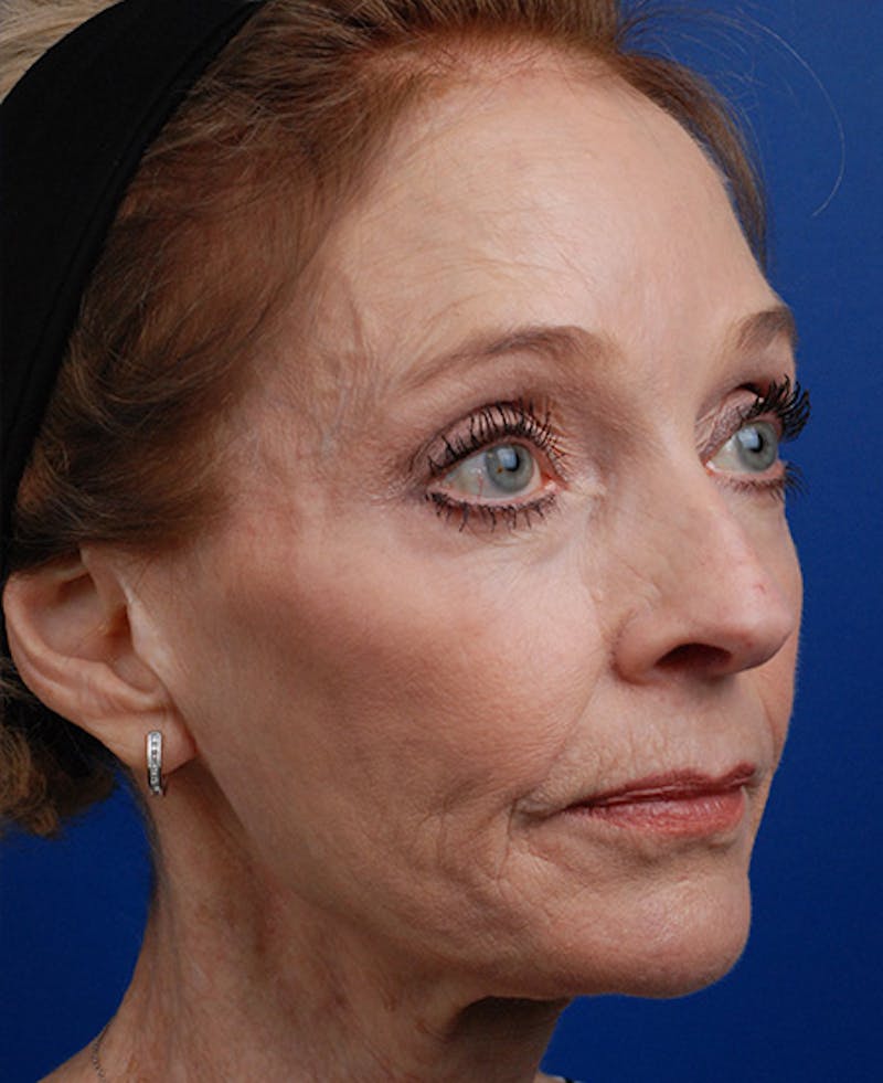 Facelift Before & After Gallery - Patient 12974014 - Image 3