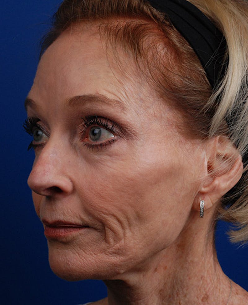 Facelift Before & After Gallery - Patient 12974014 - Image 5