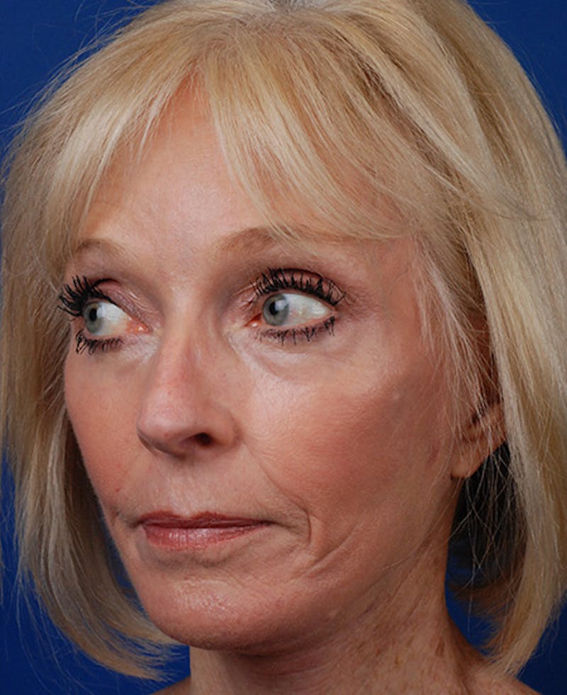 Facelift Before & After Gallery - Patient 12974014 - Image 6