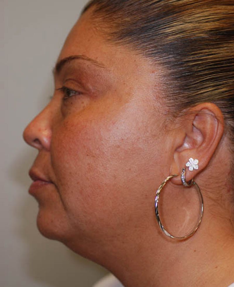 Liposuction Before & After Gallery - Patient 12974015 - Image 1