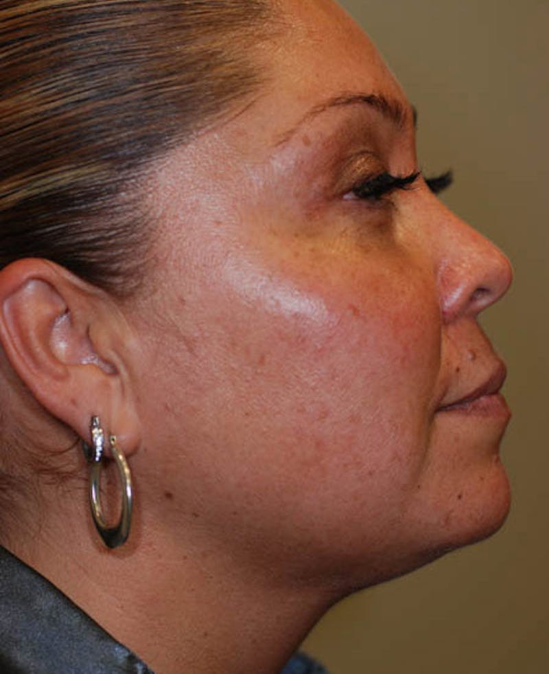 Liposuction Before & After Gallery - Patient 12974015 - Image 4