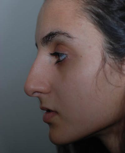 Rhinoplasty Before & After Gallery - Patient 12974017 - Image 1