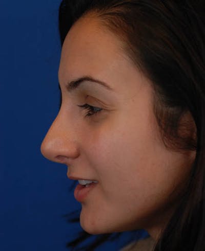 Rhinoplasty Before & After Gallery - Patient 12974017 - Image 2