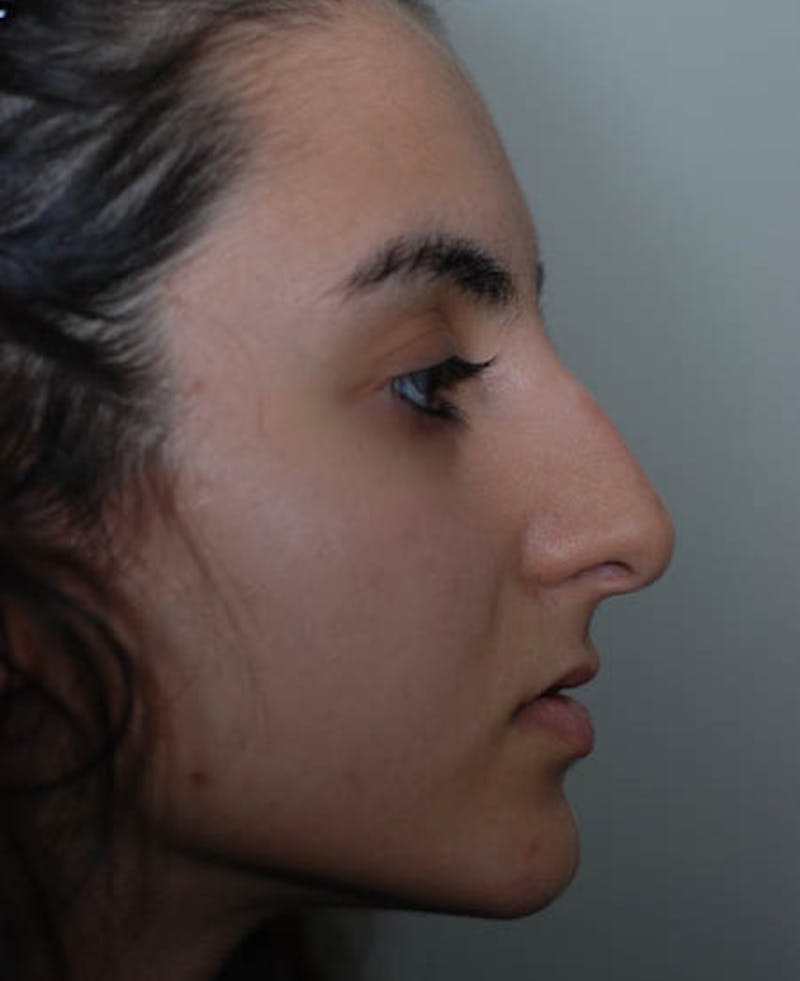 Rhinoplasty Before & After Gallery - Patient 12974017 - Image 3