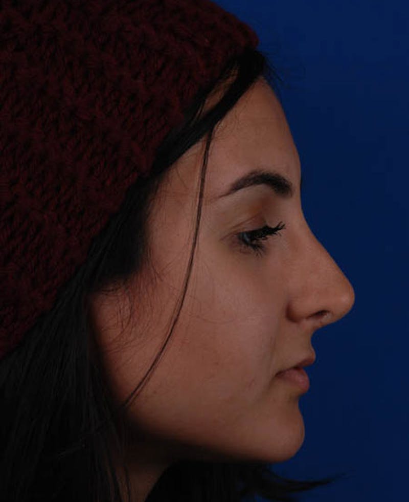 Rhinoplasty Before & After Gallery - Patient 12974017 - Image 4