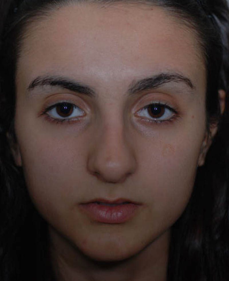 Rhinoplasty Before & After Gallery - Patient 12974017 - Image 5