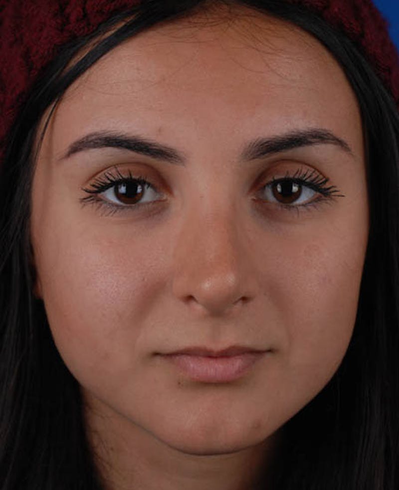 Rhinoplasty Before & After Gallery - Patient 12974017 - Image 6